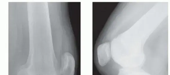 جراحة الرباط الصليبي الخلفي: دليلك الشامل لاستعادة قوة ركبتك مع الأستاذ الدكتور محمد هطيف