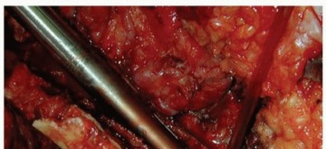 Illustration 19 for Revision THA: Why Extensively Porouscoated Cylindrical Stems Excel