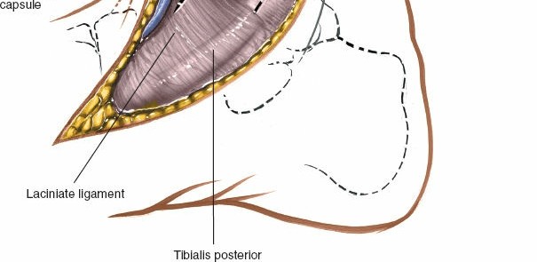 Illustration 6 for Step-by-Step Medial Side of the Ankle Approach Guide