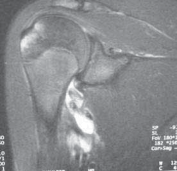 Illustration 5 for Regain Stability: Anterior Shoulder Instability Arthroscopic Fix