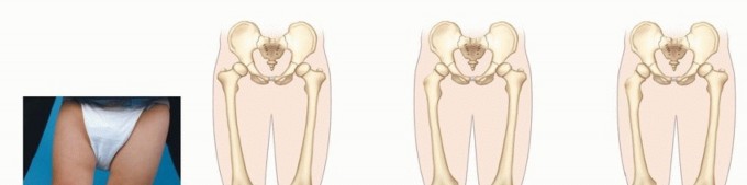 Crucial Decisions: Syme & Boyd Amputations for Fibular Deficiency