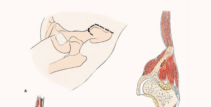 Illustration 19 for Pelvic Metastasis Surgery: A Component of the Utilitarian Approach