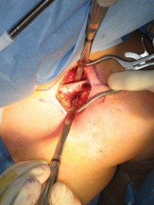 Sprengel's Deformity: Unlocking Correction with Modified Woodward Procedure