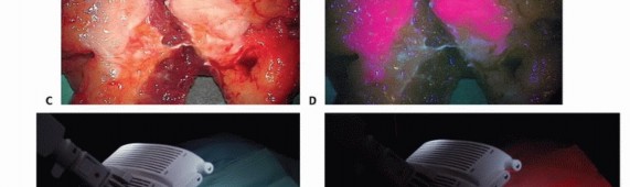 Illustration 13 for Targeted Ablation of Musculoskeletal Tumors: A Safer Approach
