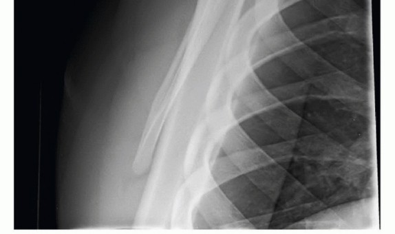 Illustration 7 for Is Your Dorsal Scapular Nerve Causing Snapping Scapula Pain?