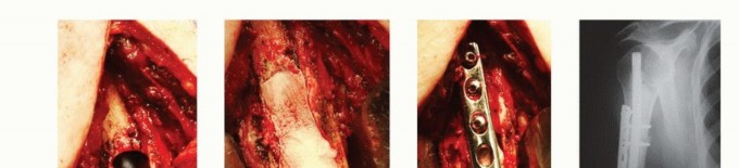 Illustration 26 for Restore Vital Function: Surgery for Type II Humeral Metastasis