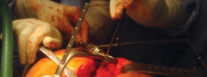 Illustration 32 for The Silent Hip: Achieving a Truly Silent, Pain-Free Joint