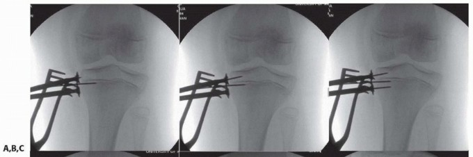Illustration 15 for Optimizing Growth to Correct Pediatric Limb Deformities