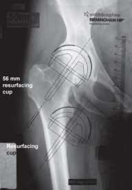 Illustration 3 for Metal on Metal Resurfacing: Enhanced Posterior Soft Tissue Repair