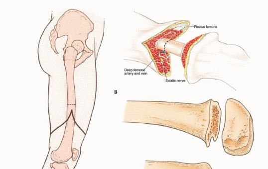 Illustration 15 for Mastering Above-Knee Amputation: Essential Surgical Insights