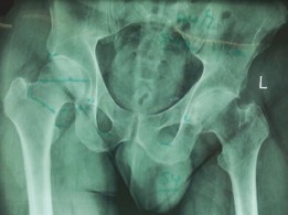 Illustration 7 for Advanced Bilateral Simultaneous THA: Uncemented Monobloc Case Title