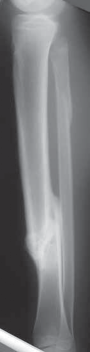 Illustration 9 for Optimal Nailing of the Tibia: Techniques for Challenging Fractures