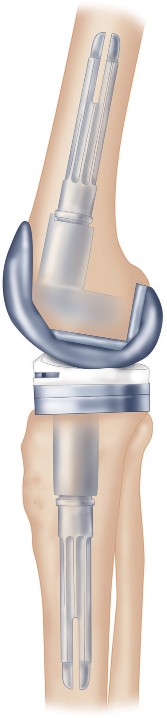 Illustration 5 for Structural Allografting Figure Guide: Solutions for Bone Deficiency