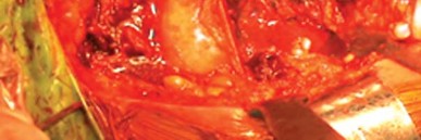 Illustration 13 for Unlock Movement: Arthroplasty for Bony Ankylosis Solutions