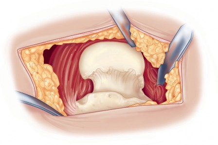 Illustration 55 for Direct Lateral Hip: Optimize Exposure with Sharp Curved Hohmann