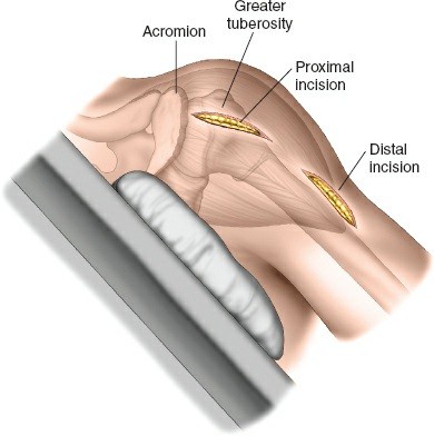 Illustration of minimally invasive lateral - Dr. Mohammed Hutaif