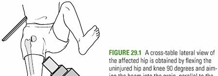 Decoding Femoral Neck Fractures: Risks, Anatomy & What to Know