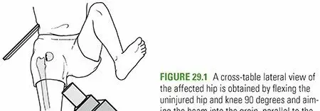 صورة توضيحية لـ كسر عنق الفخذ: دليل المريض الشامل للتعافي الكامل واستعادة الحركة مع الأستاذ الدكتور محمد هطيف