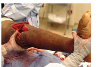 Illustration 12 for Knee Arthrodesis: A Lifelong Knee Solution for Trauma & TKA