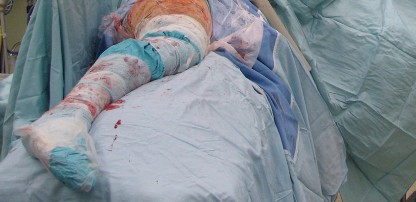 Illustration 70 for Figure Hip Resurfacing: Who Benefits and Who Should Avoid It?