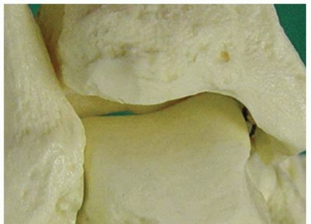 Solving Posterior Ankle Impingement Syndrome: Endoscopic Treatment