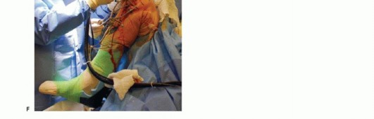 صورة طبية: استبدال مفصل الركبة الجزئي: حل متقدم لآلام الركبة المستمرة مع الأستاذ الدكتور محمد هطيف