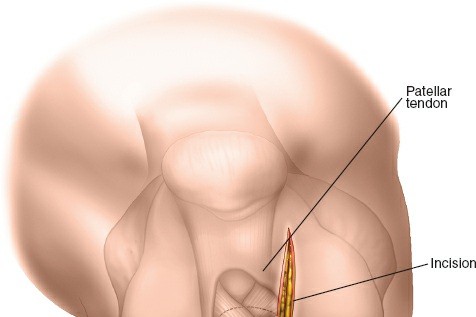 Illustration 77 for Optimal Femoral Approaches: Mastering the Lateral Intermuscular Septum