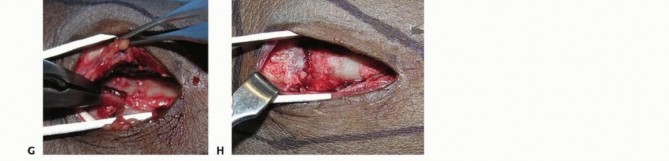 Illustration 12 for Distal Radius Fixation: Precision Through Lister's Tubercle