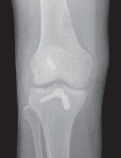 Illustration 28 for Cruciate Ligament Repair: Definitive Guide to Treatment & Recovery
