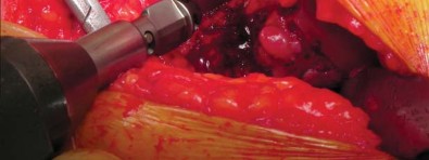 Illustration 15 for Unlock better THA: The technique of short stem for less invasiveness