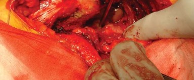 Illustration 5 for Posterolateral Surgical Approaches: Achieve Optimal Hip Replacement