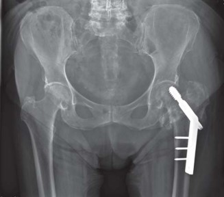 Illustration 27 for Effective Arthroplasty for Salvage of Failed Hip Fixation