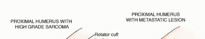 Illustration of type ii metastasis - Dr. Mohammed Hutaif