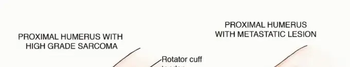 جراحة نقائل عظم العضد: دليل شامل لاستعادة الوظيفة وتخفيف الألم في اليمن مع الأستاذ الدكتور محمد هطيف