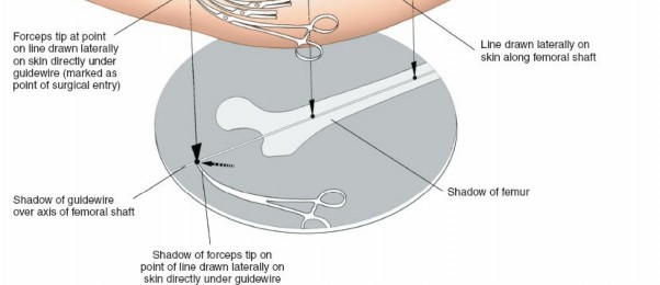 Illustration 69 for Optimal Femoral Approaches: Mastering the Lateral Intermuscular Septum