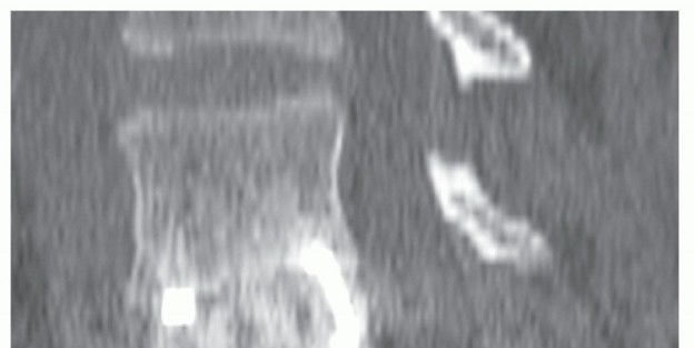 Illustration 23 for Anterior Lumbar Interbody: Fusion, Disc Replacement & Pain Relief