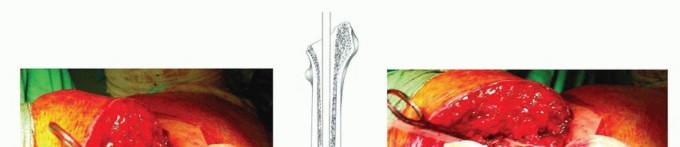 Illustration 24 for Exeter Hip Unit: Mastering Impaction Allografting for Femoral Bone Loss