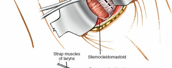 Illustration 10 for Mastering the Anterior Cervical Approach: Longus Colli Muscle Insights