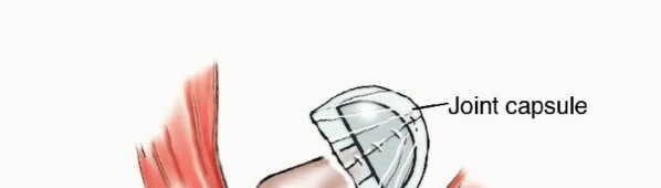 Illustration 3 for Beyond Amputation: Total Femur Resection with Endoprosthetics