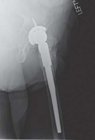 Illustration 29 for Effective Arthroplasty for Salvage of Failed Hip Fixation