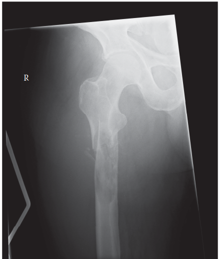 Pathological Fracture Explained: Radiographic Clues & Causes