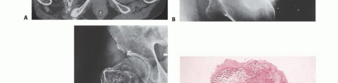 Illustration 44 for Understanding Benign Bone Tumors: Your Complete Preoperative Guide