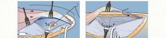 Illustration 44 for Treatment for Congenital Femoral Deficiency: What You Need to Know