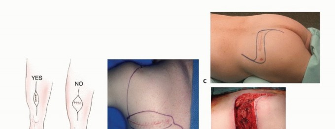 Illustration 37 for Precision Biopsy of Musculoskeletal Tumors for Accurate Diagnosis