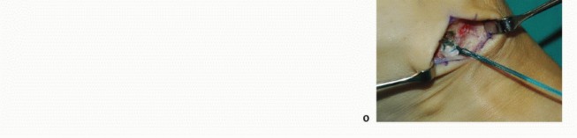 Illustration 21 for Foot Drop Surgery: How a Pin or Drill Elevates Tendon Transfer