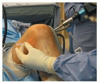 Illustration 8 for Posterior Cruciate Ligament Surgery: Regain Knee Strength & Stability