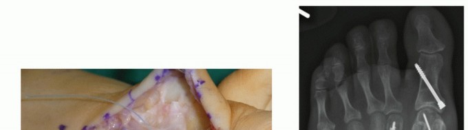 Akin Osteotomy: Unpacking Akin's Role in Hallux Valgus