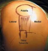 Illustration 5 for Knee Arthroplasty Unicondylar: Discover if Partial Knee Replacement is Right