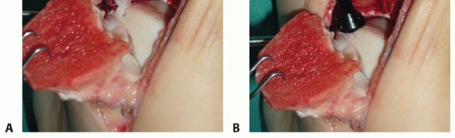Illustration 15 for Painful Talus Lesions? The tech fig c Osteochondral Transfer Solution