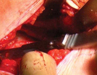 Illustration 6 for Mastering the Anterolateral Approach in Minimally Invasive Hip Replacement